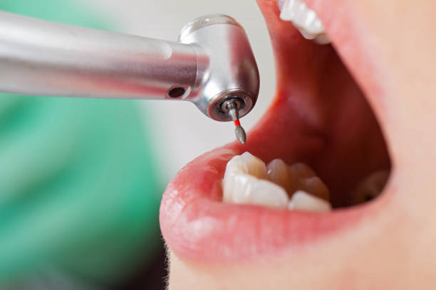 Best Emergency Dentist for Lost Fillings or Crowns in Fruit Heights, UT